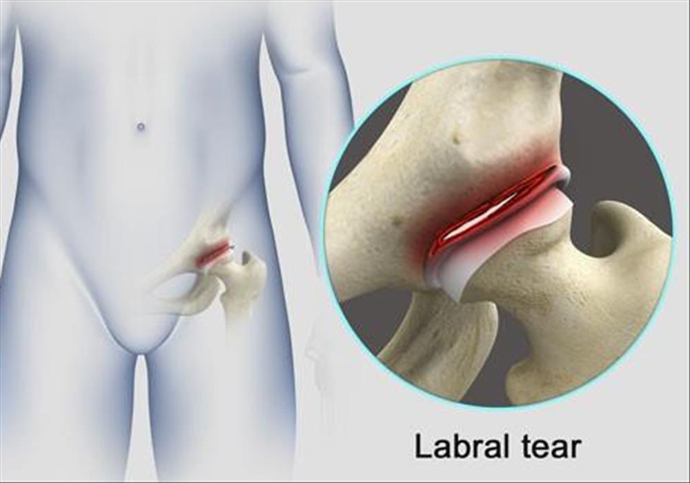 Do You Have A Painful Hip Labral Tear Have You Considered This 